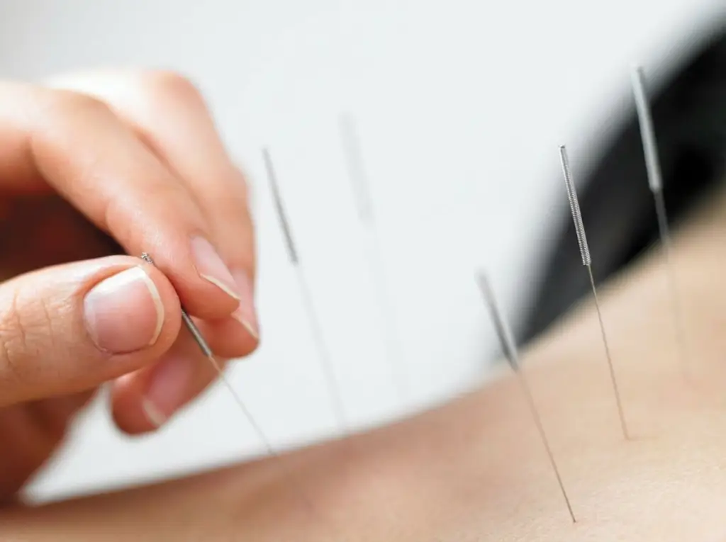 acupuncture